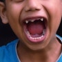 유치에서 영구치로, 하지만 치아 맹출에 문제나 장애가 있다면?