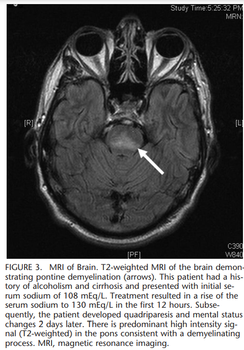 osmotic demyelination syndrome(ODS) : 네이버 블로그