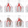 치아흡수성병변 진행단계/자연치료 여부/치아흡수성병변 증상 및 예방