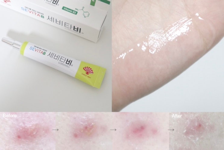세비타비겔 가격 화농성 여드름연고 내돈내산 후기 : 네이버 블로그