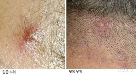 피부염,부스럼(옹종,종기,뾰루지)피부진균,화농 : 네이버 블로그