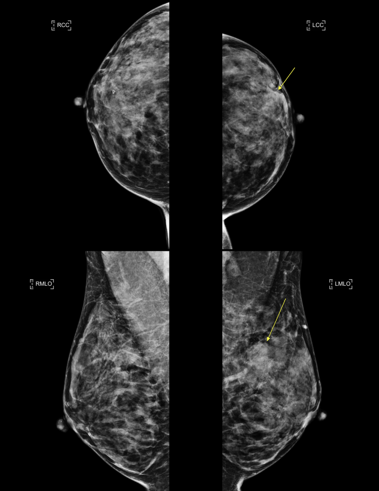 유방촬영술에서 유방조직구성 - Breast composition, parenchymal pattern in mammography ...