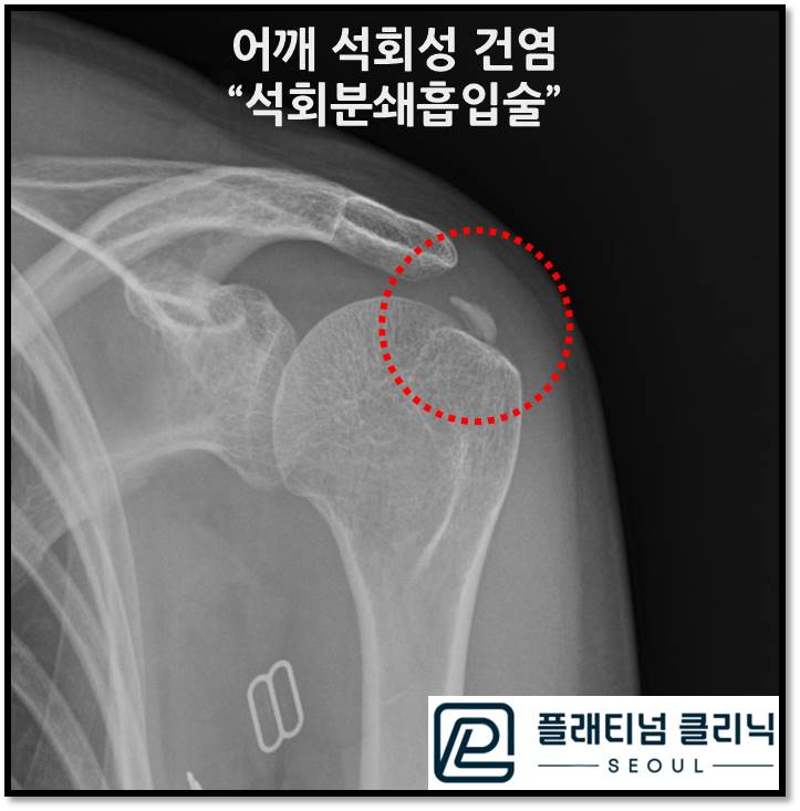 (플래티넘의원) 석회성 건염 비수술적으로 한번에 치료합니다.