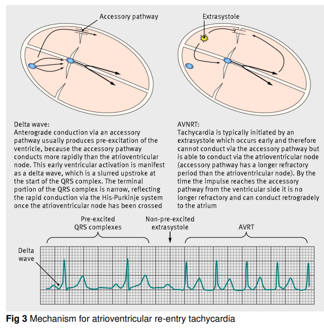 AVRT(AV reentry tachycardia), 방실 회귀성 빈맥 종류 2가지 : 네이버 블로그