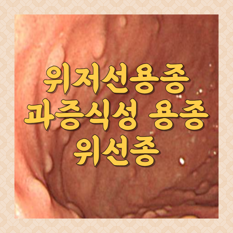 위저선용종 과증식성용종 위선종 총정리 : 네이버 블로그