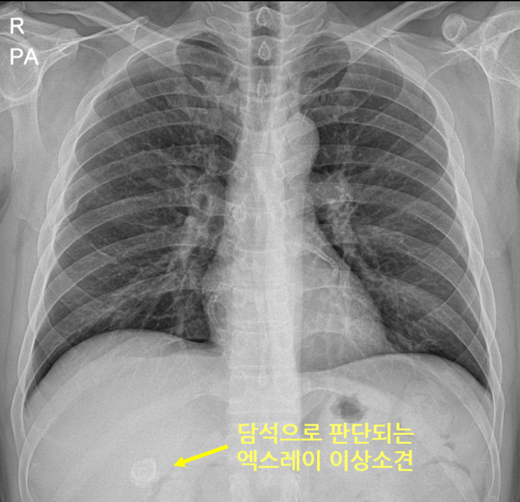 흉부 엑스레이에 우연히 관찰된 담석 증례 / 풍암동 소문난내과 : 네이버 블로그