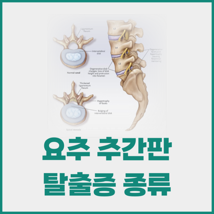 [추천도수치료사]체형교정 요추 추간판 탈출증 종류 알아보기 : 네이버 블로그