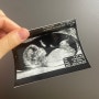 [임신 12주차~15주차] 병원 전원하기, 1차 기형아 검사(니프트vs통합선별혈액검사), 증상 공유