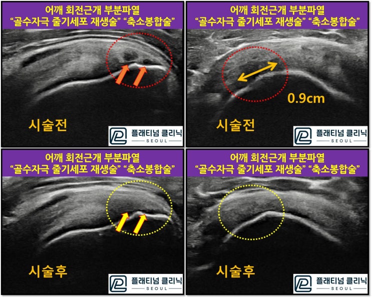 (플래티넘의원)회전근개 파열 비수술적으로 치료할 수 있습니다.