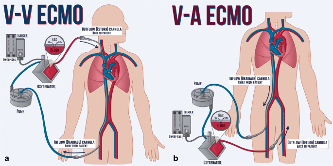 ECMO(extracorporeal membrane oxygenation) : 네이버 블로그