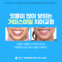 일산치과 [잇몸과다노출 거미스마일] 잇몸이 많이보이는 개방교합 거미스마일 교정치료 후기