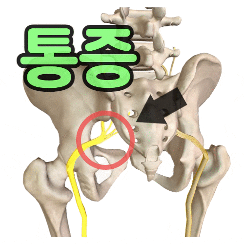 좌골신경통 증상 병원 원인별 치료 운동 금기증 : 네이버 블로그