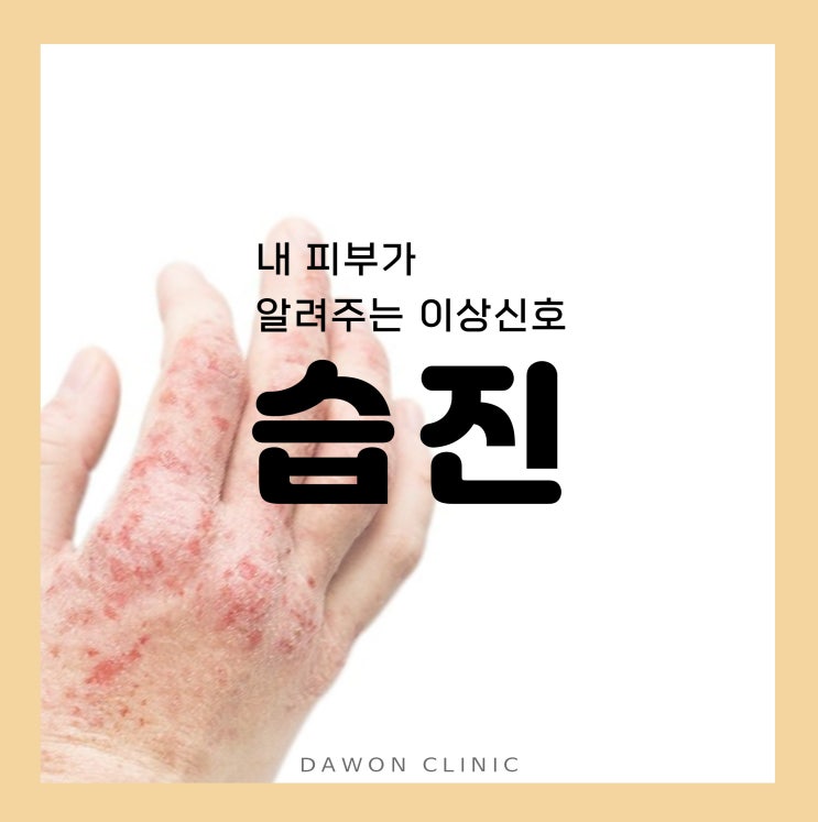 대구서구피부과) 습진 피부염 개선하고 싶다면? 습진의 원인과 치료. : 네이버 블로그