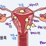 자궁물혹 증상 무증상 ~ 비정상 자궁내출혈