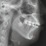 턱끝 보형물 제거, 재수술 (이부성형수술) 관련 궁금증