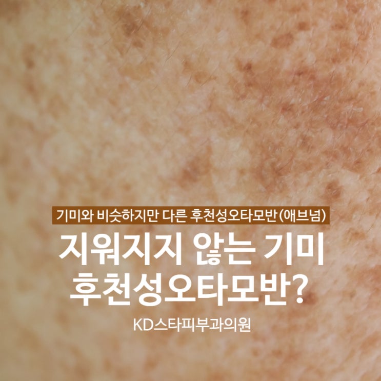 상일동역피부과_기미레이저 후 진해졌다면 후천성 오타모반(애브넘)을 의심 : 네이버 블로그