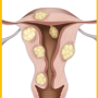양산 에델여성의원 자궁근종 수술