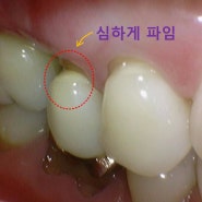 하남 지식산업센터 치과 치아 파임이 심해졌을 때 치경부 마모증 합병증