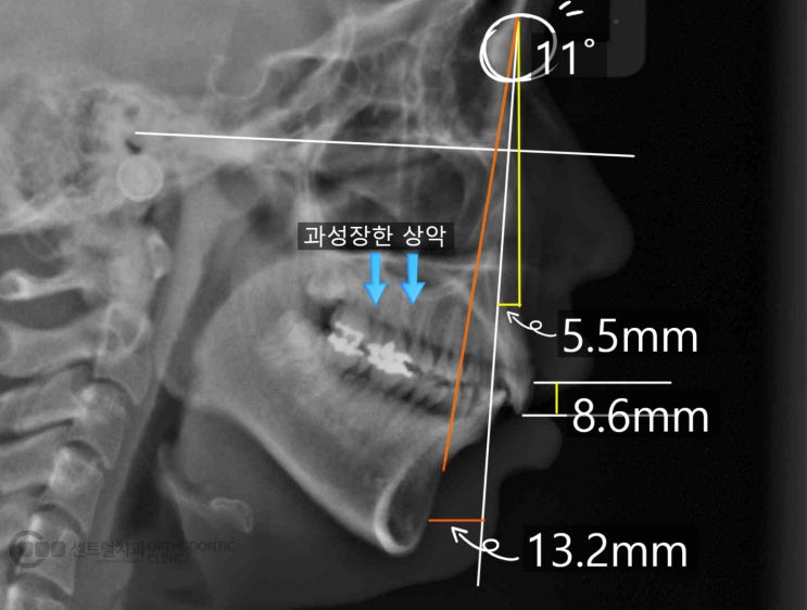 잇몸돌출 무턱 현상을 동반하는 2급 부정교합의 교정 치료 : 네이버 블로그