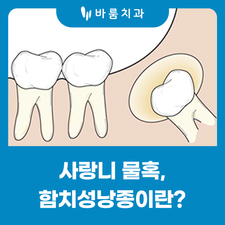 함치성낭종 물혹 매복사랑니 방치한다면 : 네이버 블로그