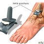 발목 인공 관절 수술 후 재발 방지를 위한 올바른 관리
