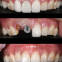 앞니 통증, 치아뿌리염증으로 재신경치료 및 변색된 치아 미백 동반하여 앞니지르코니아 크라운 치료. 선릉 치과