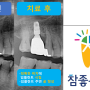 47- 임플란트 붇고 피나요 : 임플란트주위염(peri-implantitis)으로 임플란트 제거 후 즉시 임플란트 식립, 티타늄메쉬를 이용한 뼈이식(골유도재생술)까지 하루에 다하기