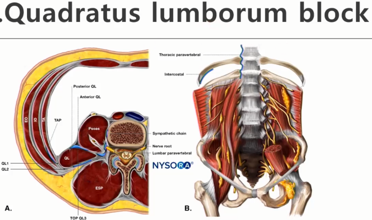 [요추]★Quadratus lumborum block : ★옆구리★, 양옆 허리근육아프다는 환자 : 네이버 블로그