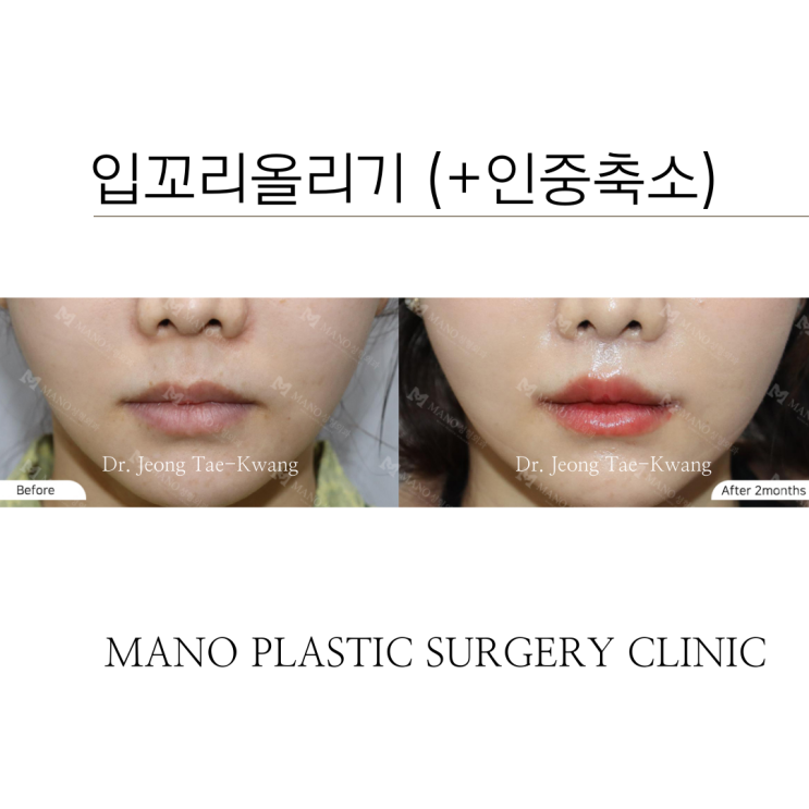 입꼬리수술부작용 종류와 입꼬리 올리는 방법 : 네이버 블로그