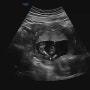 (임신)16주차 입체초음파/성별