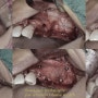 치조제 증강술을 동반한 상악동 거상술(Sinus lift with alveolar bone augmentation using Sausage technique)