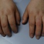절단된 손가락에 진짜 같은 맞춤 손가락 의수족 전문!!