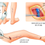 [대연동 하지정맥류] 하지정맥류 수술 종류