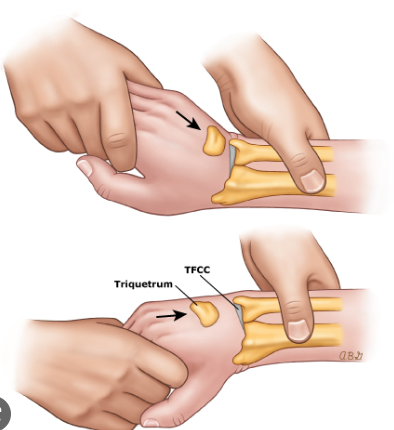 TFCC injury ｜ tfcc치료 방법 선택 어떻게 하나요? [보존적 치료 vs 수술] -2 tfcc 한의원 : 네이버 블로그