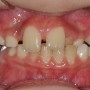 대구어린이교정] 치아때문에 입을 다물면 얼굴이 삐뚤어집니다(인비절라인 퍼스트)