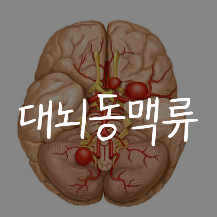 대뇌동맥류 파열되지 않은 뇌동맥류 원인과 증상 : 네이버 블로그