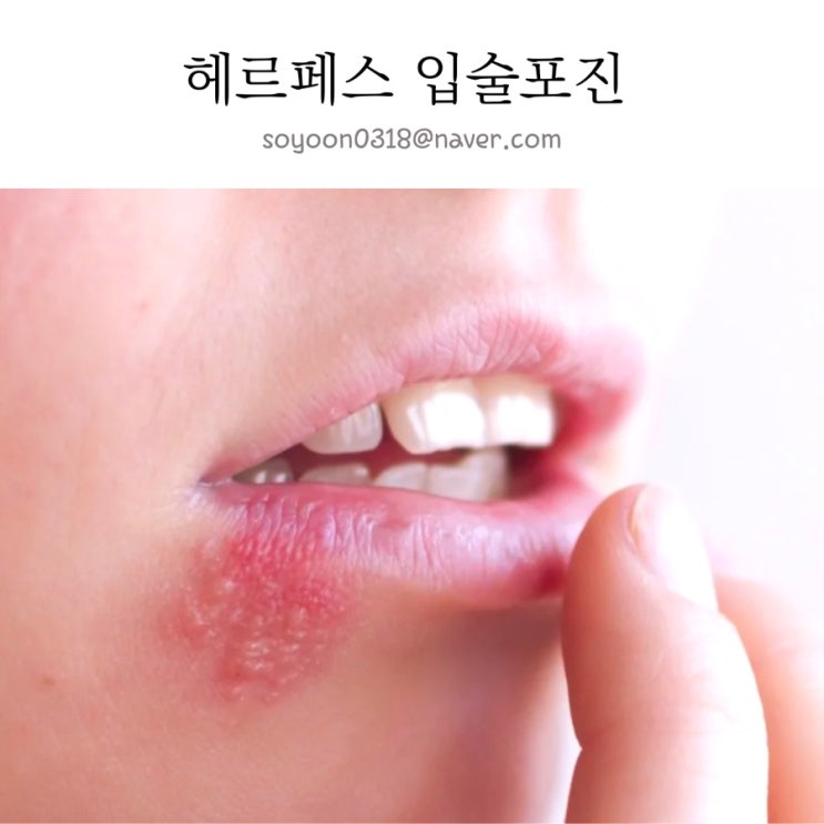 입술 헤르페스 전염 증상 원인 입술포진 약 아시클로버 연고와 정 알약 치료 비교! : 네이버 블로그
