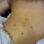 [Dr.ParK] 뒷 목 염증성 피지 낭종 핀홀법 제거 수술