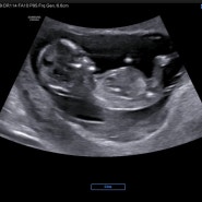 임신일기 | 임신 중기 13주~20주 증상, 성별 확인, 첫 태동 느낌