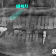 당산동치과 발치 후 즉시 임플란트 식립으로 구강기능 회복!