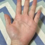 [짧은 일기] 손목 터널 증후군 수술 후 1년 / 현재 상태 / 흉터 등