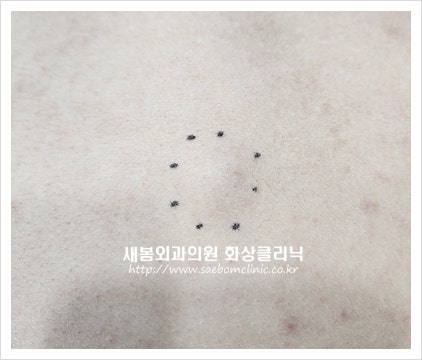 [일산 피지낭종 수술] 등에 생긴 피지(표피)낭종 핀홀법, 최소절개 수술 : 네이버 블로그