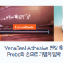 [부산 대연동 하지정맥류] 베나실(VenaSeal)시술 방법