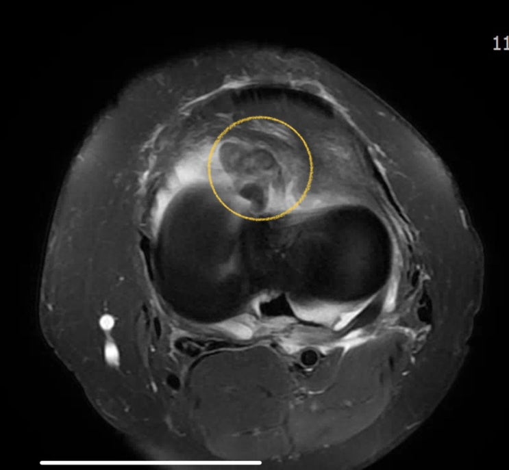 PVNS(색소 융모 결절성 활막염)의 특징, 증상, MRI 소견 및 치료. 40대 여자 환자분의 반복적인 무릎 물참 증상 케이스 ...