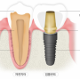 [전주혁신도시치과] 임플란트 Q&A
