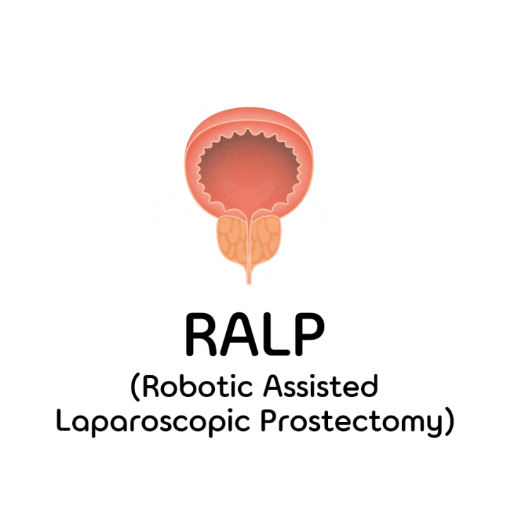 Robotic Assisted Laparoscopic Prostectomy (RALP) : 네이버 블로그