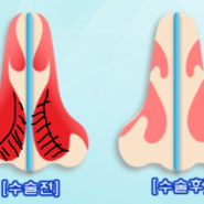 부비동염(축농증) 내시경 수술/ 풍선확장술, 하비갑개 점막하 절제술/ 비중격만곡 교정수술