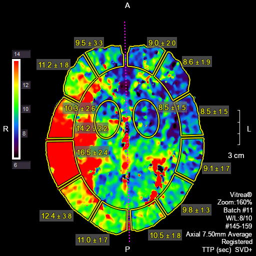 CT Perfusion (CTP) with diamox (acetazolamide) 판독양식 - step wise ...