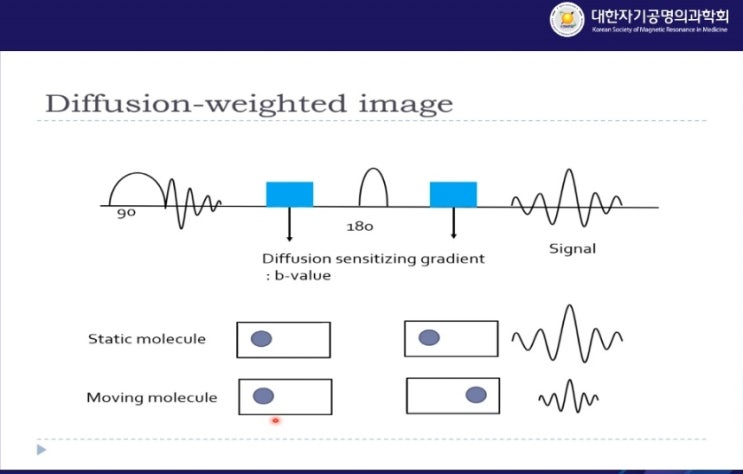 Diffusion weighted Image(DWI) : 네이버 블로그
