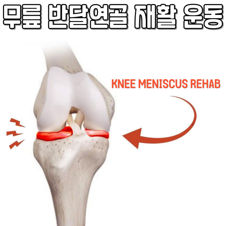 무릎 반달연골 재활 운동(반월상연골, MENISCUS) : 네이버 블로그